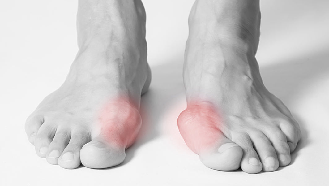 Adolescent with rearfoot Valgus