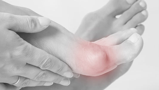 Hallux Valgus